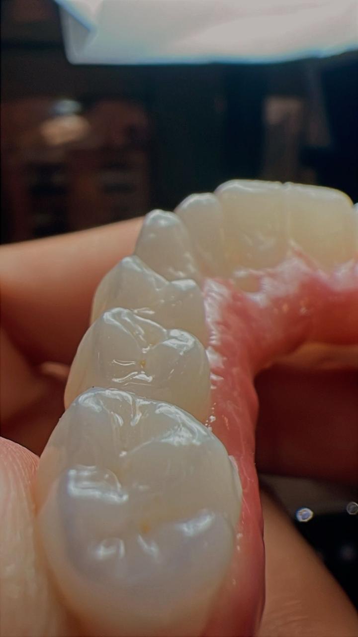 Prótese fixa sobre dentes naturais
